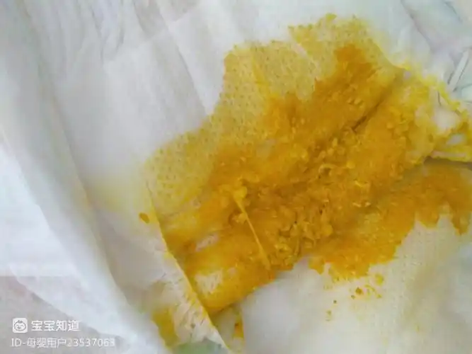 母乳喂养的宝宝的便便如图好像有好奶瓣是消化不良么