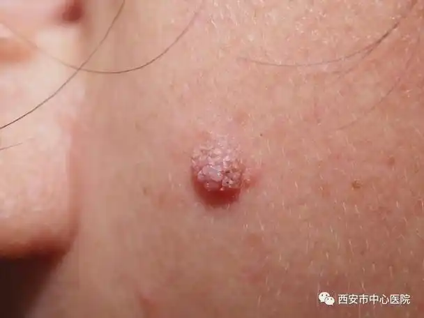 皮肤上长的瘊子怎么弄掉(皮肤上的小瘊子)(3)