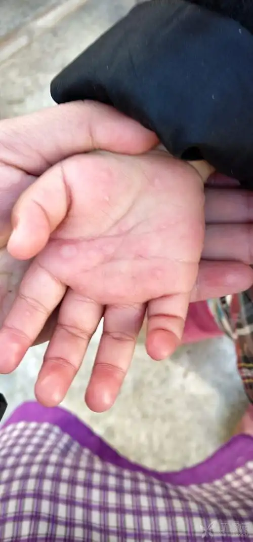 目前多发的孩子皮肤疱疹问题.