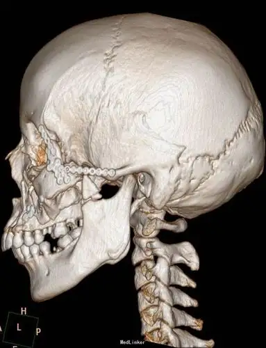 左侧颌面部骨折