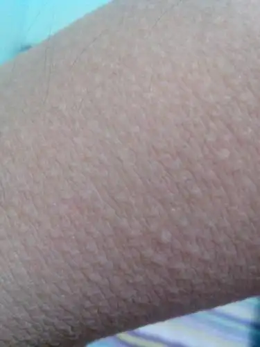 皮肤上有鸡皮疙瘩,什么原因?怎么去除?