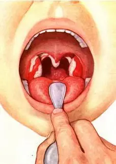 疱疹性咽炎:多见于7岁以下儿童,起病急,突发高热,起病12小时后,软腭