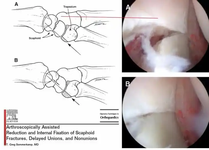 专题教程舟状骨骨折的7种手术入路详解