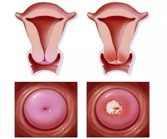 同房后阴道出血了患上宫颈癌了不一定