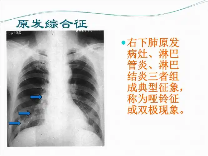 肺结核的分型精编版