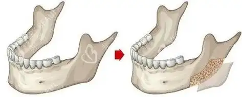 劈外板手术就是将三明治形态的下颌骨的外侧皮质骨进行劈开去除,从而