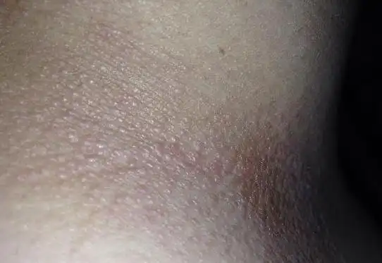 我的脖子,腋下长了一些小肉粒,不痛不痒,是怎么回事.