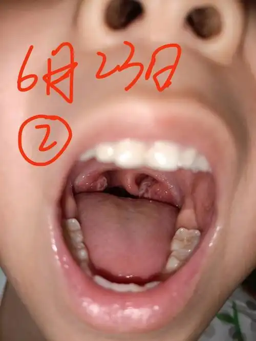 一星期一次,第五次因为前几天有点咳嗽,可能有炎症,去烙了后扁桃体