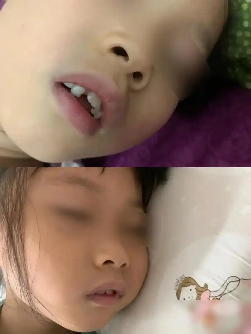 孩子一旦形成腺样体面容就不是手术能解决的问题!孩子天天在父 - 抖音