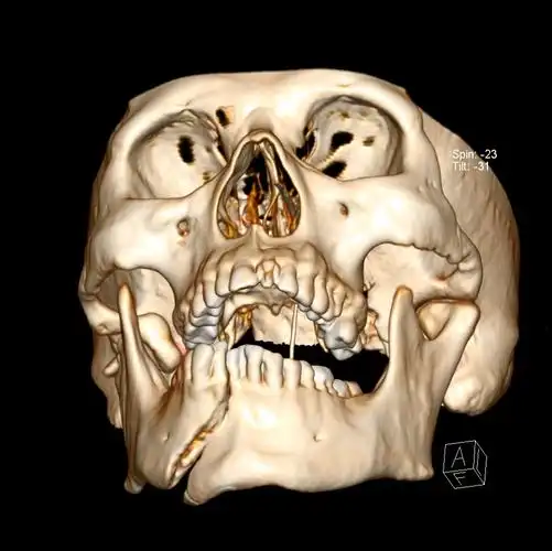 医院北口腔科完成耳屏前经面神经陈旧性下颌骨髁状突,水平段骨折一例