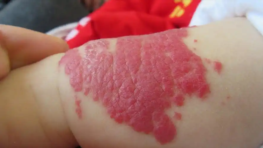 婴儿头上有红色的东西(宝宝身上的胎记是否有害) - 乐宝宝贝