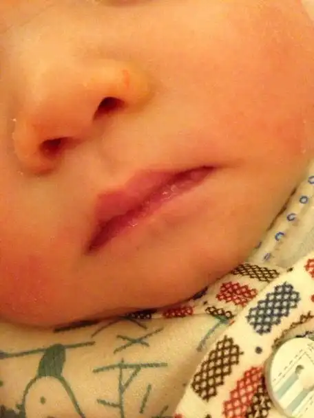 16:53    浏览  33333  推荐回答 您好,小婴儿出现频繁呛奶,口吐泡泡