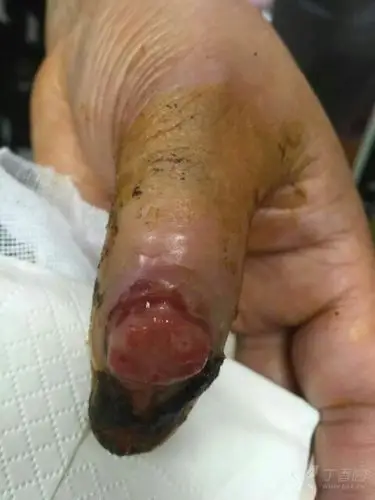 医院换了20来天,长成这样,那长出的肉芽有必要剪掉吗 - 皮肤与性传播