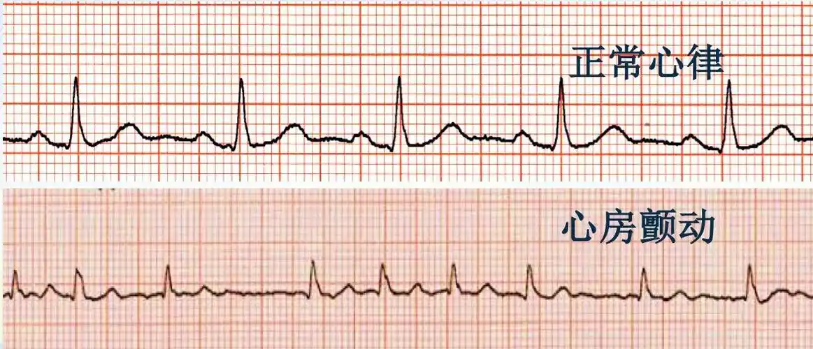 房颤都是通过心电图检查来确诊的,通常确诊方式有以下几种:1)体检做心