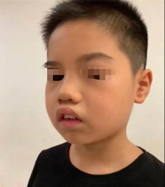 快来看看腺样体面容有多丑|你也希望自己的孩子变成这样吗?