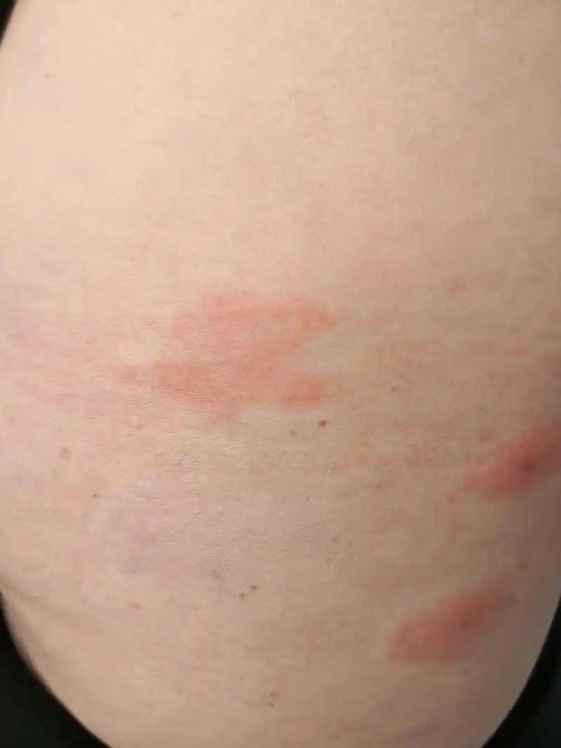 带状疱疹早期症状.老年女性.