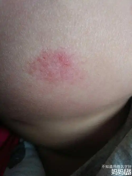 血管瘤是什么,如果你想让你的孩子健康,不妨进来看【带图】 - 北京妈