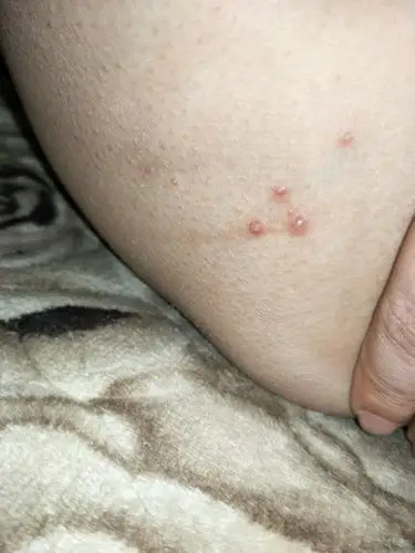 大腿内侧长了几个包,一直没消,也不痛不痒.