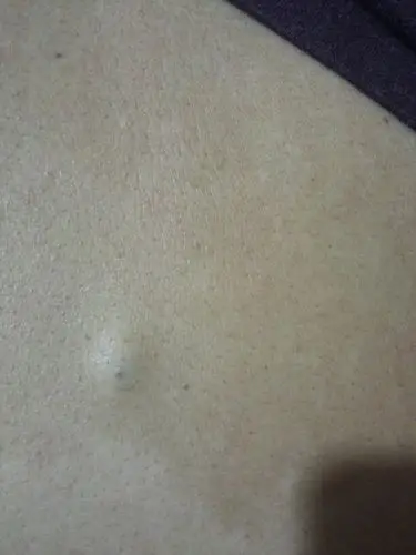 后背长了亇小硬块,好几年了,今天挤出橡皮泥样东西,而且很难闻是什么