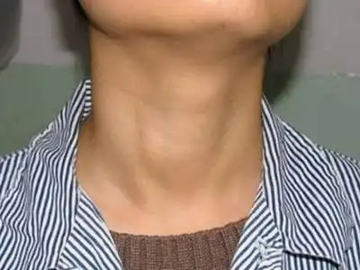 甲亢脖子症状图片 (51)