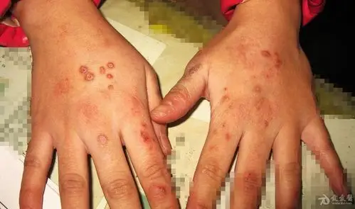 这是什么皮肤病变应性血管炎