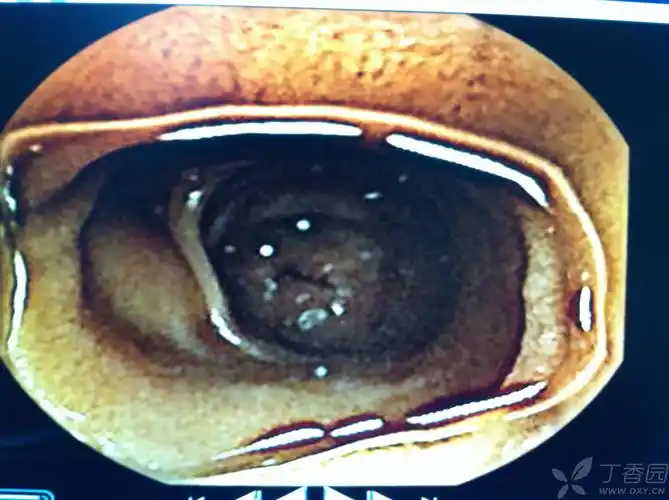 【原创】胶囊内镜一些有意思的图片