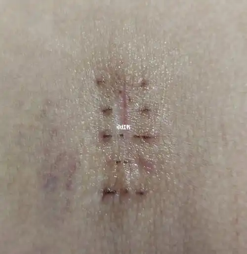 左胯上又发现一个,还算小吧,目测1cm,也没有黑色的孔,不知道是脂肪瘤