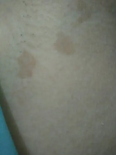 是汗斑吗,怎么祛除?谢谢