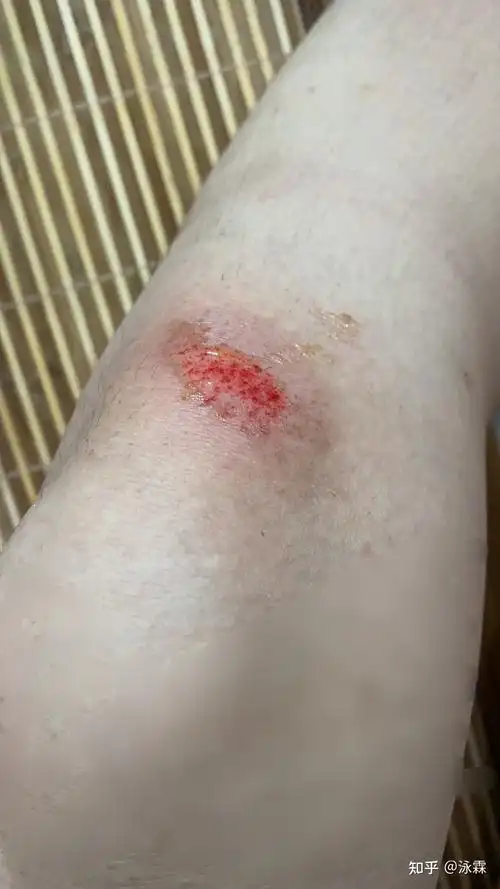 记录打球膝盖擦伤后处理进程