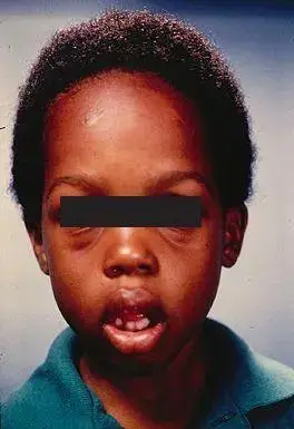 牙列不齐,上切牙突出,唇厚,缺乏表情,神情呆滞,出现所谓"腺样体面容"