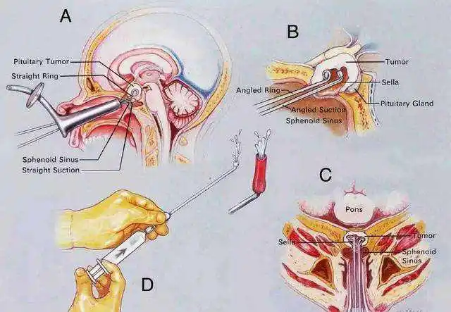 益阳市三医院神经外科成功开展经鼻蝶窦垂体瘤切除术