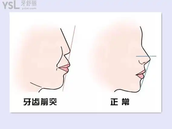 首先要到正规的牙科医院判断是骨性的还是牙性.