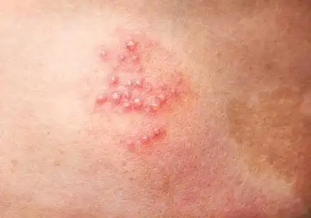 单纯疱疹病毒1型和2型第一种疱疹会在嘴唇和鼻子的粘膜上引起水疱.