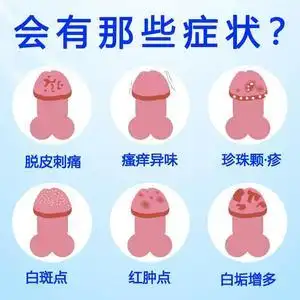 龟头炎症溃烂皮裂白垢红肿脱皮殖冠状沟瘙痒霉uli开毒男包性生清