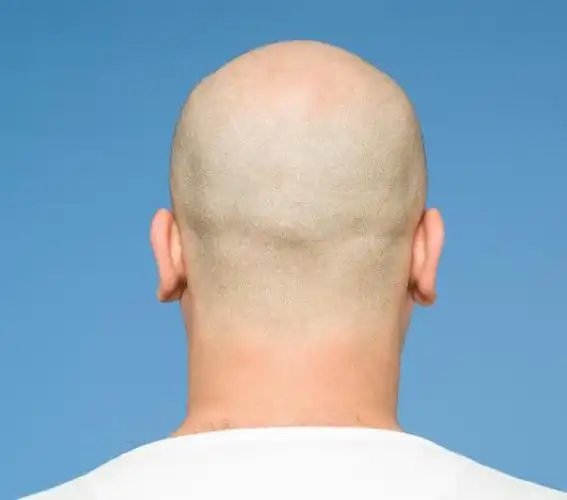 把头发剪短,剃光头能避免脱发吗?