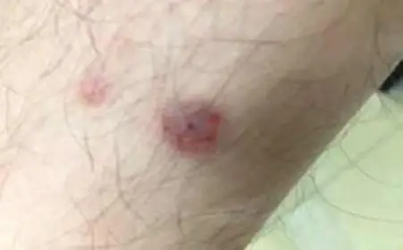 男性   男性一期梅毒症状是,生殖器周围疹子增多,并且迅速糜烂形成