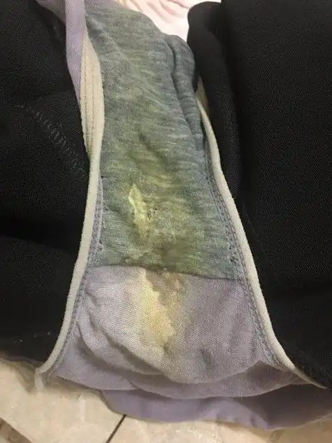 精斑是在受到性刺激的情况下所出现的射精或流出的前列腺液粘在内裤或