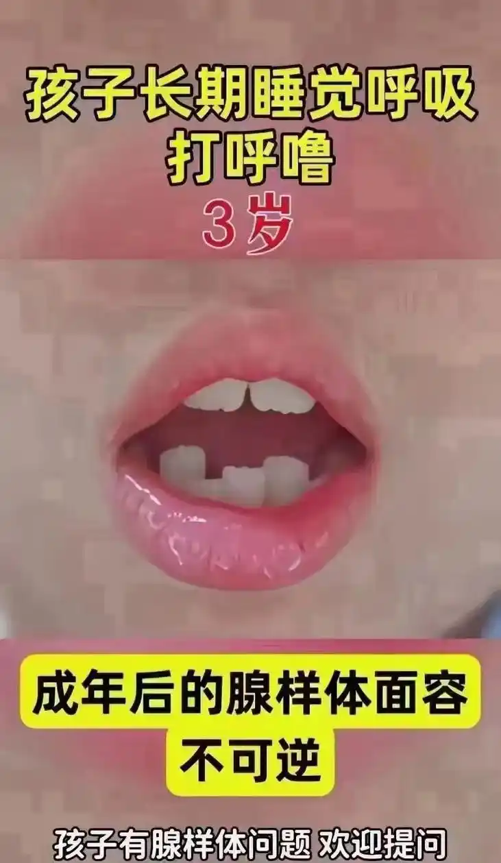 最近很多人问我腺样体面容啥样子,总结一下腺样体面容和危害