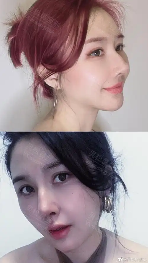 吴松鼻整形##美国射极峰##生活中好看的鼻子##名品鼻三要素##鼻整挝