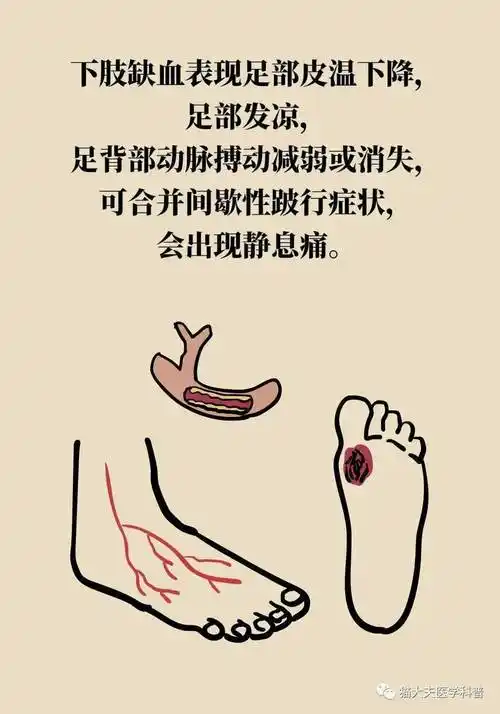 漫画科普 | 从"高危足"开始干预,可预防50%的糖尿病足或截肢的发生