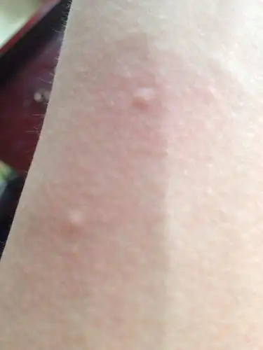 每次洗澡之后身上会有这样的红疙瘩,很痒,过一会就没了,好几年了,怎么