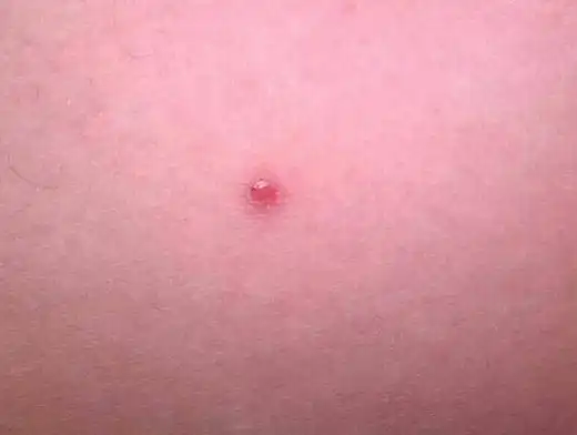 男性梅毒的初期症状