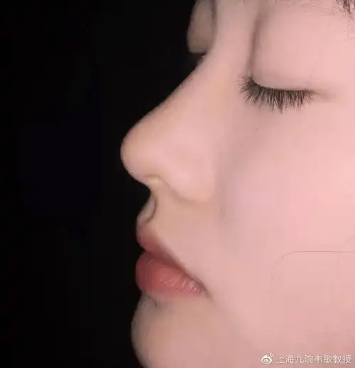 图片所以一个好看,自然的鼻子,除了讲究美学设计,假体材料的选择外