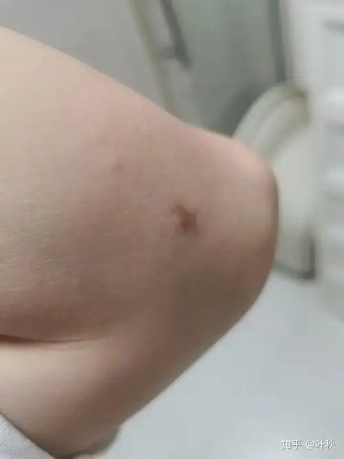 脂肪瘤术后万再一次分享