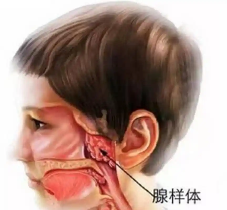 打呼噜3个月,腺样体肥大四分之三 扁桃体二度肿大  最近有很多腺样体
