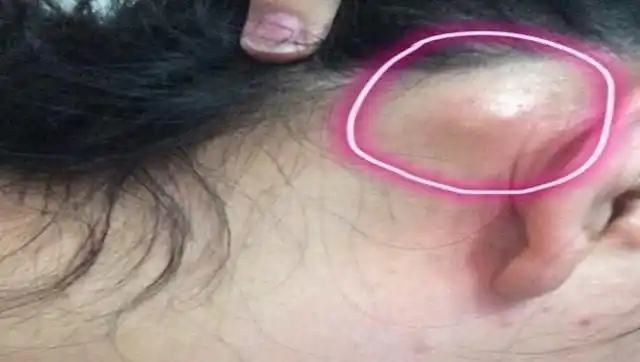 耳朵后长了这个,别不当回事儿,恶化成肿瘤后悔都来不及