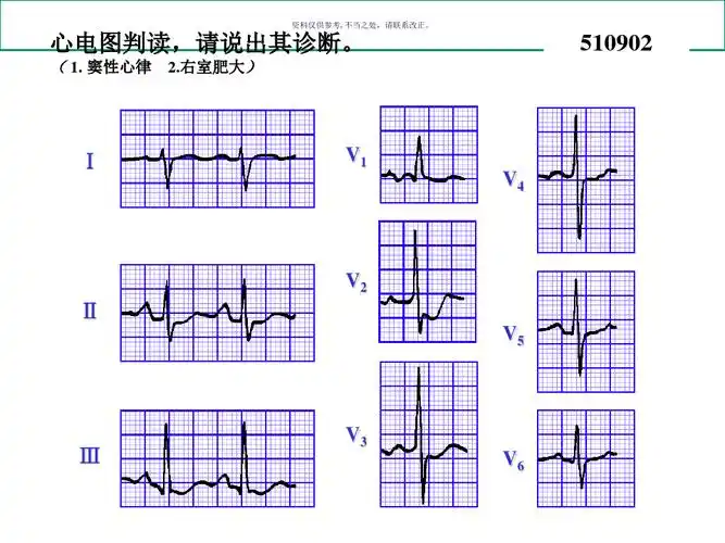 心电图试题和答案