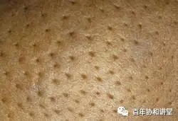 百年协和讲堂 | 乳头溢液,酒窝征?身体出现这些变化,警惕乳腺癌