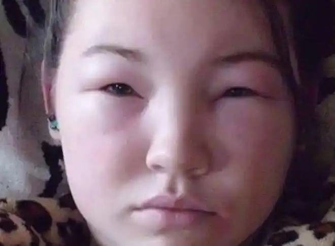 尿毒症越来越普遍要是脸上出现这3种现象说明肾脏危险了