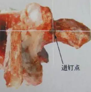 (1)magerl定位法腰椎椎弓根钉置钉定位方法较多,最常用的有magerl定位